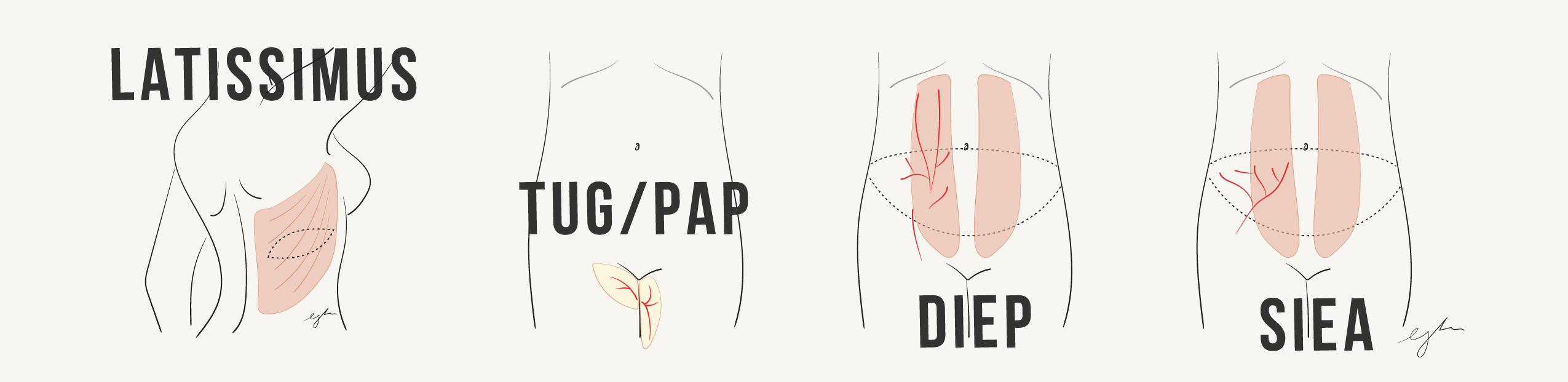 flap options