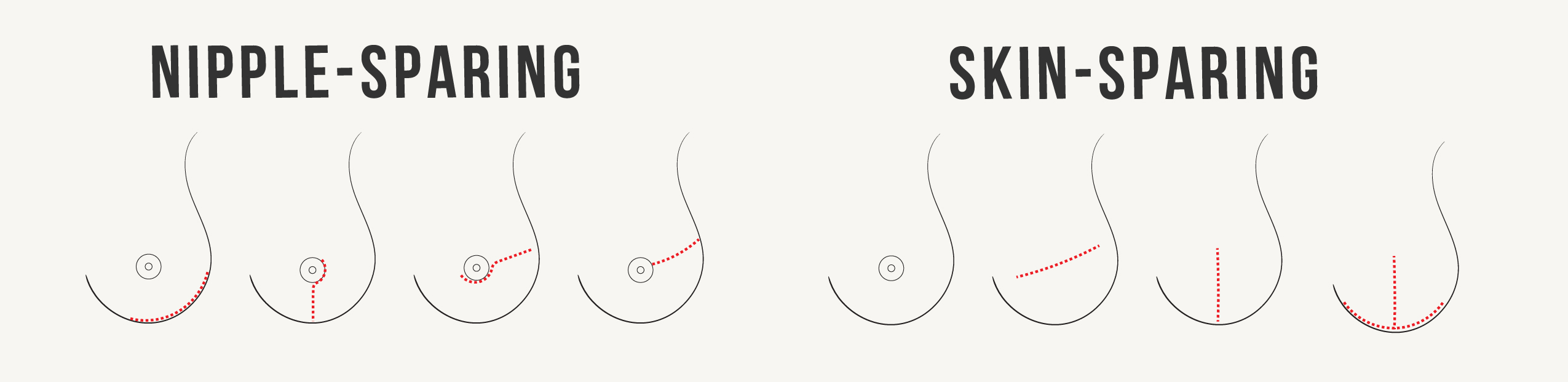 mastectomy incision types