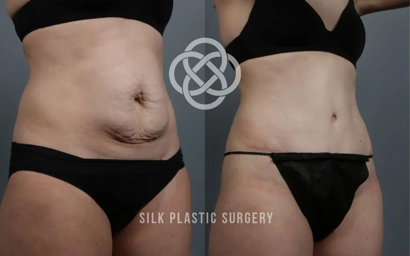 abdominoplasty