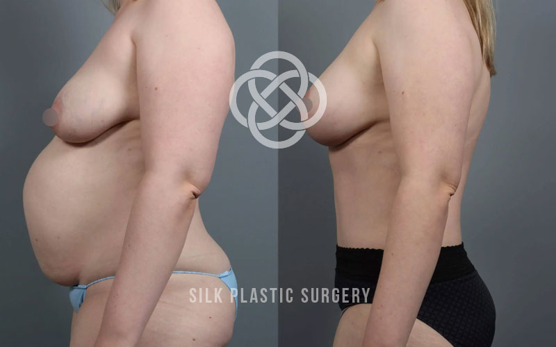 abdominoplasty