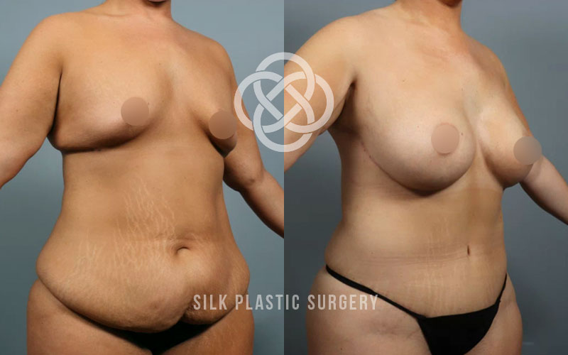 abdominoplasty