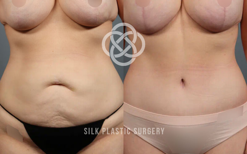 abdominoplasty