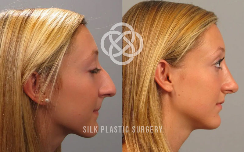 rhinoplasty