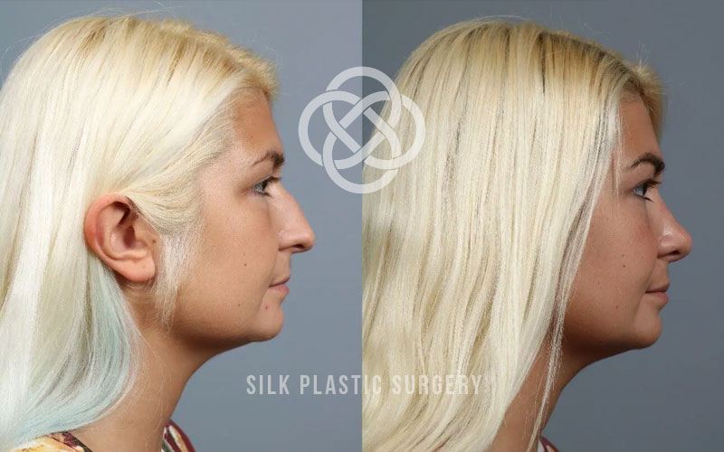 rhinoplasty