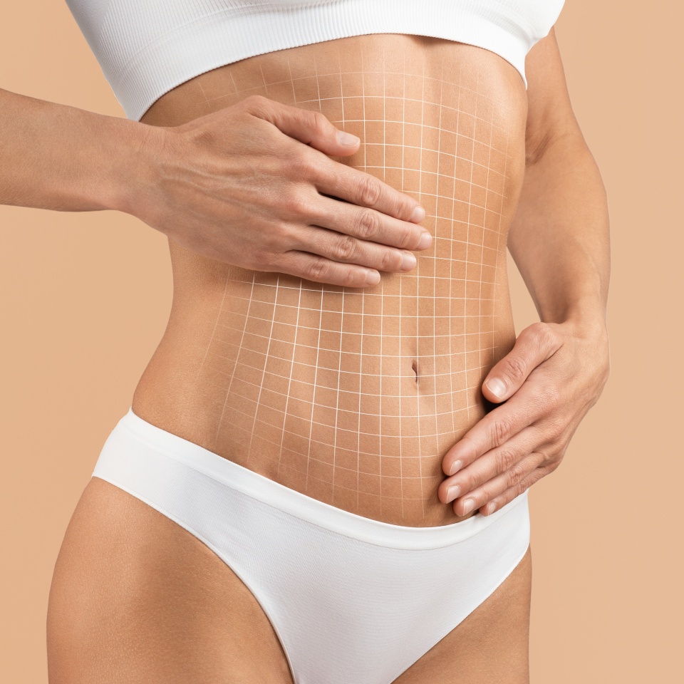 Tummy Tuck. Cropped Shot Of Female Body With Flat Abdomen And Drawn Mesh, Creative Collage With Unrecognizable Young Woman In Underwear Demonstrating Liposuction Or Plastic Surgery Result On Abs