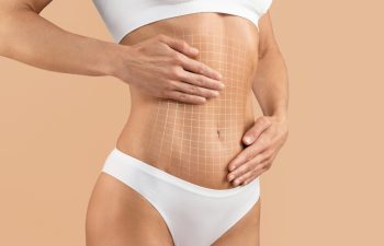 Tummy Tuck. Cropped Shot Of Female Body With Flat Abdomen And Drawn Mesh, Creative Collage With Unrecognizable Young Woman In Underwear Demonstrating Liposuction Or Plastic Surgery Result On Abs