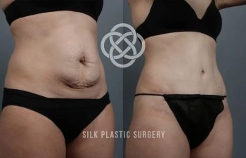 Side-by-side comparison of a woman's abdomen before and after plastic surgery, showing reduced loose skin and a smoother appearance.