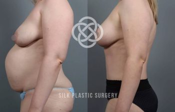 Side-by-side comparison of a woman’s torso before and after plastic surgery, showing reduced abdominal size and lifted breasts.