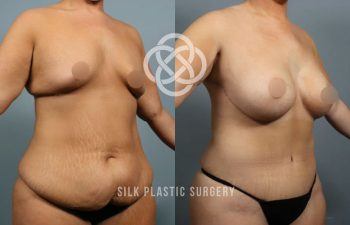Before and after photos of a woman showing body contouring results, with visible changes in the abdomen and breasts. Logo and text "Silk Plastic Surgery" overlaid on image.