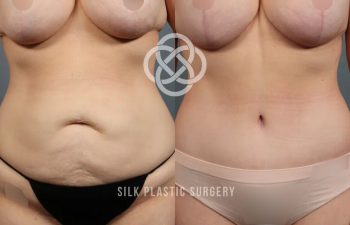 Before and after photos of a woman’s abdomen showing reduced excess skin and fat following cosmetic surgery, with “SILK PLASTIC SURGERY” text overlay.
