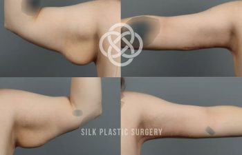 Before-and-after photos of an arm showing reduction in sagging skin and improved contour following plastic surgery.