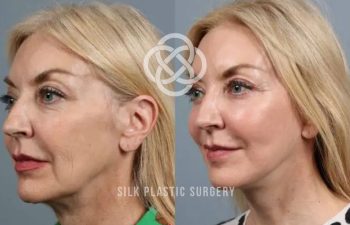 Side-by-side comparison of a woman’s face before and after plastic surgery, showing smoother skin and fewer wrinkles in the after image; both images have "Silk Plastic Surgery" watermark.