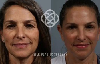 Side-by-side before and after photos of a woman’s face, showing reduced wrinkles and smoother skin following a cosmetic procedure. "Silk Plastic Surgery" logo is overlaid on the image.