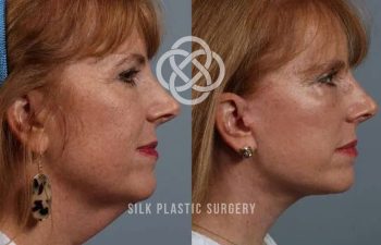 Side-by-side before and after profile photos of a woman showing reduced nasal hump and smoother nose contour after rhinoplasty.