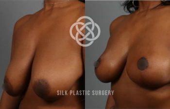 Before-and-after photo showing a woman's chest following breast lift surgery, with visible improvement in breast shape and position. Text reads "SILK PLASTIC SURGERY.