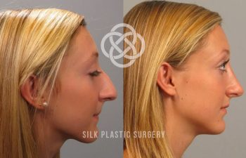 Side-by-side profile photos of a woman before and after rhinoplasty, showing a noticeable reduction in nose size and a straighter nasal bridge. "Silk Plastic Surgery" watermark is present.