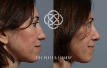 Side-by-side profile photos of a woman before and after rhinoplasty, showing changes in nose shape. Logo and "SILK PLASTIC SURGERY" text overlay the images.