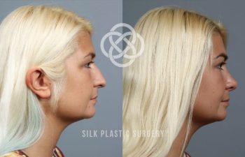 Side-by-side profile photos of a woman before and after cosmetic ear surgery, showing reduced ear protrusion. "Silk Plastic Surgery" watermark is visible.