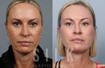 Facelift patient before and after treatment – front view