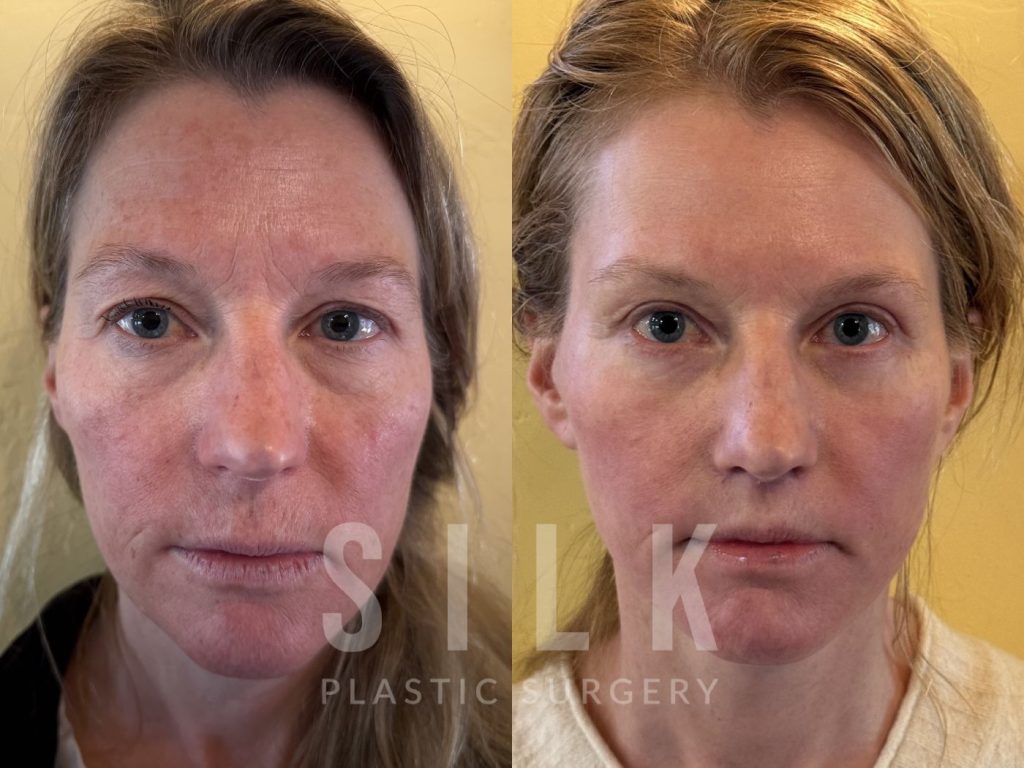 Facelift patient before and after treatment – front view