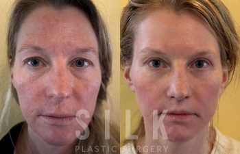 Facelift patient before and after treatment – front view