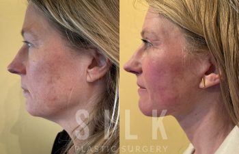 Facelift patient before and after treatment – left side view
