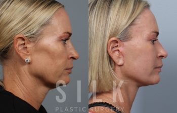 Facelift patient before and after treatment – right side view