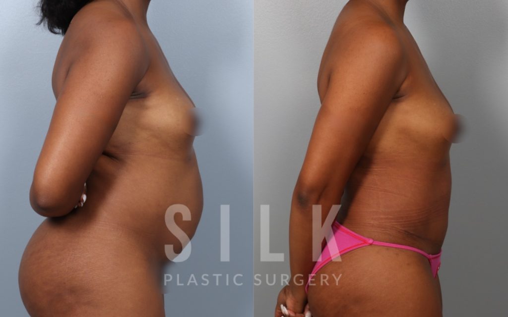 Patient before and 3 months post op Abdominoplasty with rectus diastasis repair, procedure performed by Dr. Urquia