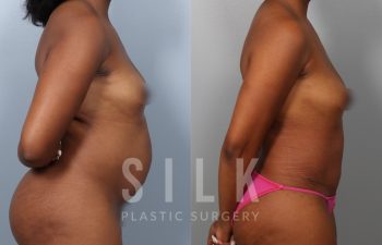Patient before and 3 months post op Abdominoplasty with rectus diastasis repair, procedure performed by Dr. Urquia