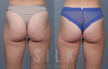 Liposuction of Outer thighs & Flanks done by Dr. Mackay     Pre-op and 6 months post op