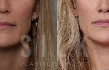Lip Lift done by Dr. Mackay Pre-op and 2 months post op