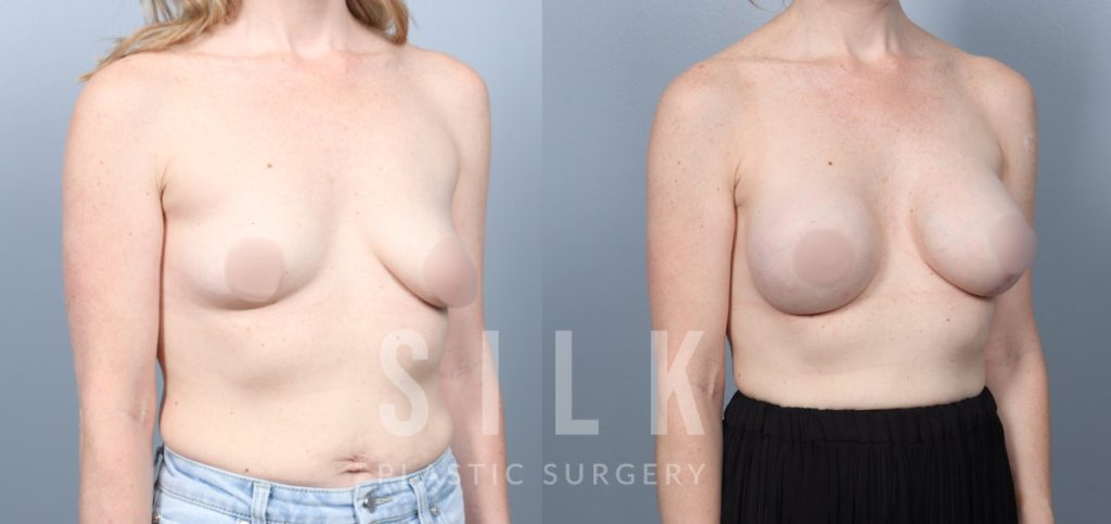 Breast Augmentation with Fat Grafting Pre-op and 6 months post op
