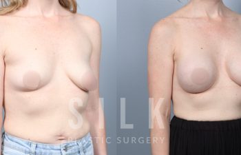 Breast Augmentation with Fat Grafting Pre-op and 6 months post op