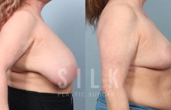 Patient before and 2 months post op Bilateral breast reduction - right side view, procedure performed by Dr. Urquia