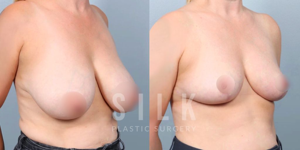 Patient before and 4 months post op Bilateral breast reduction - right oblique view, procedure performed by Dr. Urquia