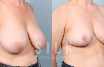 Patient before and 4 months post op Bilateral breast reduction - right oblique view, procedure performed by Dr. Urquia