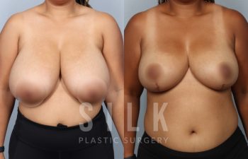 Patient before and 6 months post op Bilateral breast reduction - front view; procedure performed by Dr. Urquia