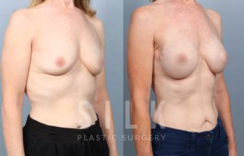Patient before and 6 months after direct to implant reconstruction after endoscopic mastectomy, procedure performed by Dr. Urquia